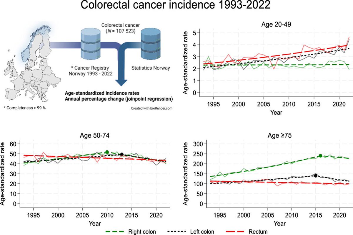 Erman_Akkus's tweet image. 🚨Early-onset colorectal cancer (EOCRC, 20-49 y) incidence is increasing worldwide: Norway data
@ESMO_Open 

➡️1993 and 2022
❗️Incidence of EOCRC increased by 66% (average annual percentage change, AAPC 1.3)
❗️Mainly left-sided colon and rectal cancers
✔️Age group 50-74 years:…