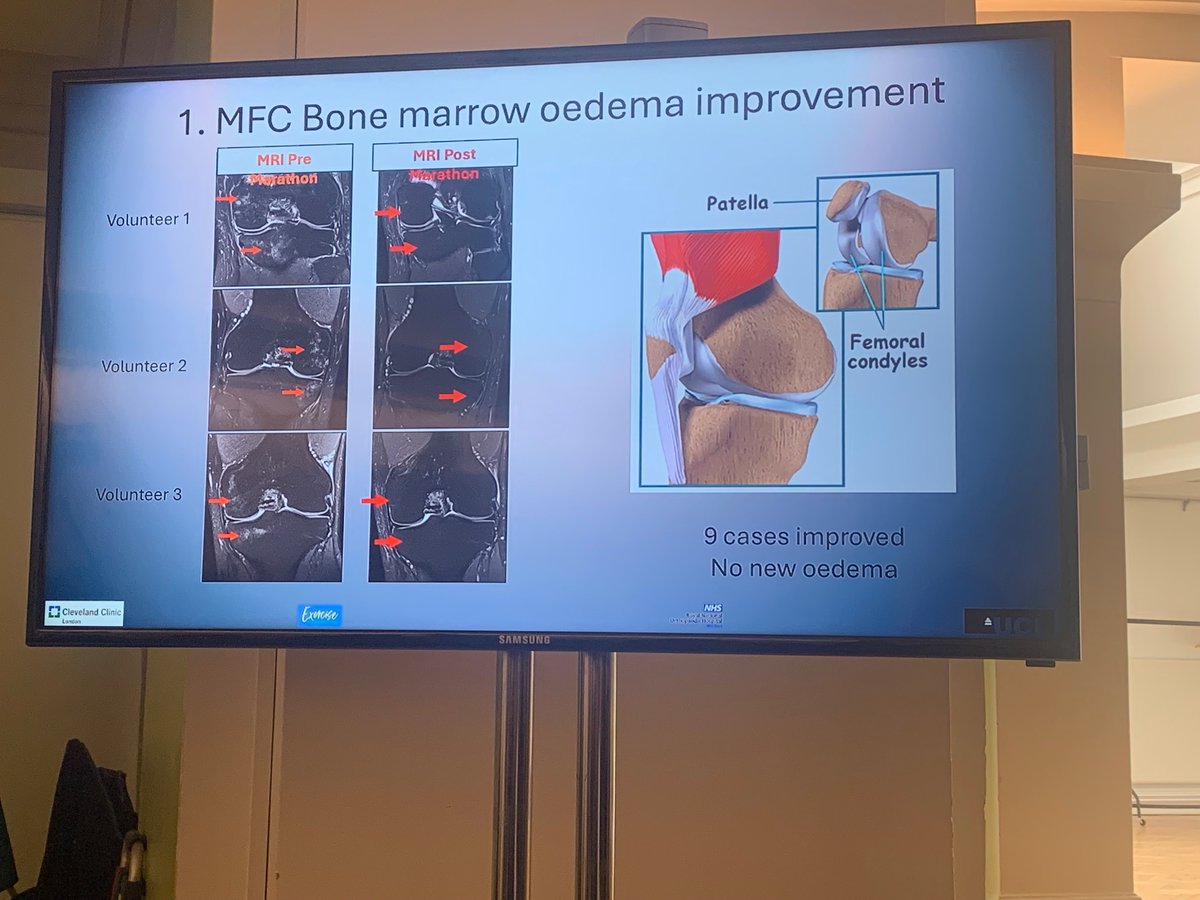 Great news for everyone running in @LondonMarathon tomorrow… Running a marathon is good for your joints 🥳🏃🏼‍♀️🏃🏻‍♂️🏃🏼 Fantastic talk from Prof. Alister Hart @marathonmed this morning. Also shared the important message of osteoarthritis is NOT wear and tear! #MM40