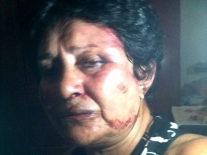 El rostro de la dictadura cubana. En las fotos, de 2013, la actriz Ana Luisa Rubio, que fuera salvajemente golpeada en un acto de repudio convocado por el régimen. Fue ingresada en el hospital Manuel Fajardo en la la noche del 6 de septiembre de 2013. ¿Cuál fue su «delito»? Ser