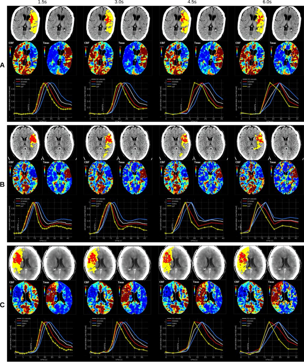 Rau, A., Reisert, M., Stein, T. et al. Impact of temporal resolution on perfusion metrics, therapy decision, and radiation dose reduction in brain CT perfusion in patients with suspected stroke. Neuroradiology 66, 749–759 (2024). doi.org/10.1007/s00234…