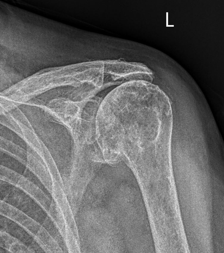 20/4/2024. 🟢What´s the likely cause of omarthrosis in this patient? Why? 🫸
1⃣ CPPD. 
2⃣ Rotator cuff arthropathy. 
3⃣ Trauma. 
Reply with your insights! 🧠 #Radiology #MSKRad #traumatwitter #orthotwitter