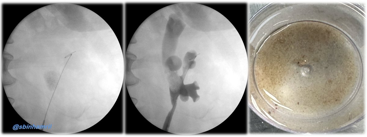 👉 DISS 🆚 FANS 💡 Stop doing Imaging Post Procedure , Simply remove the stent @PETRAurogroup @PEARLSendouro