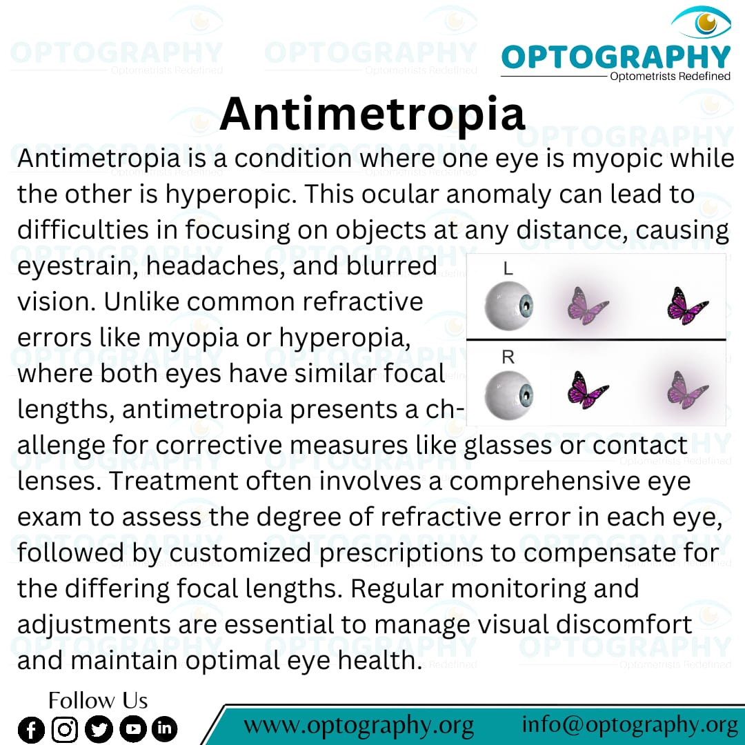 Antimetropia: A rare eye condition where one eye is nearsighted while the other is farsighted. It can cause visual discomfort and difficulty focusing.
#Antimetropia #Eyehealth
#Optography #Optometry
#Optometrist