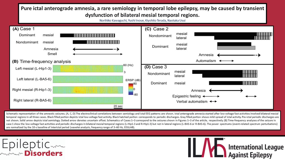 Kawaguchi et al. describe electroclinical characteristics of pure amnestic seizures using intracranial video-EEG in three patients with mesial temporal lobe epilepsy. @JLAlcalaZermeno @RoohiKatyal @fabnascimen @SBeniczky onlinelibrary.wiley.com/doi/10.1002/ep…