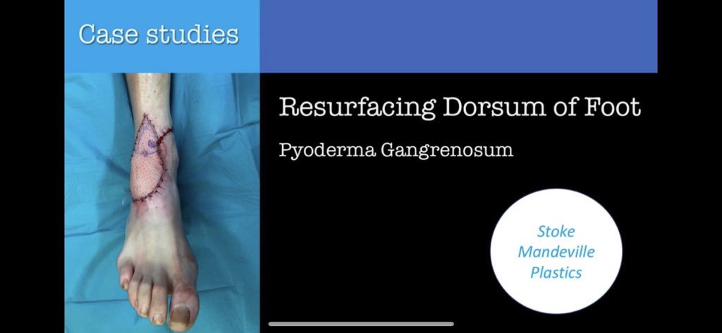 Pyoderma Gangrenosum is a rare skin disorder & a recon nightmare as surgery can make it worse. Here we overcame this prob with periop immunosuppression. What’s your experience? @BAPRASvoice @ICOPLASTsurgery @plasticstrainee @PlasticsFella @BOFAS_UK youtu.be/DTr3GyDYIKI?si…