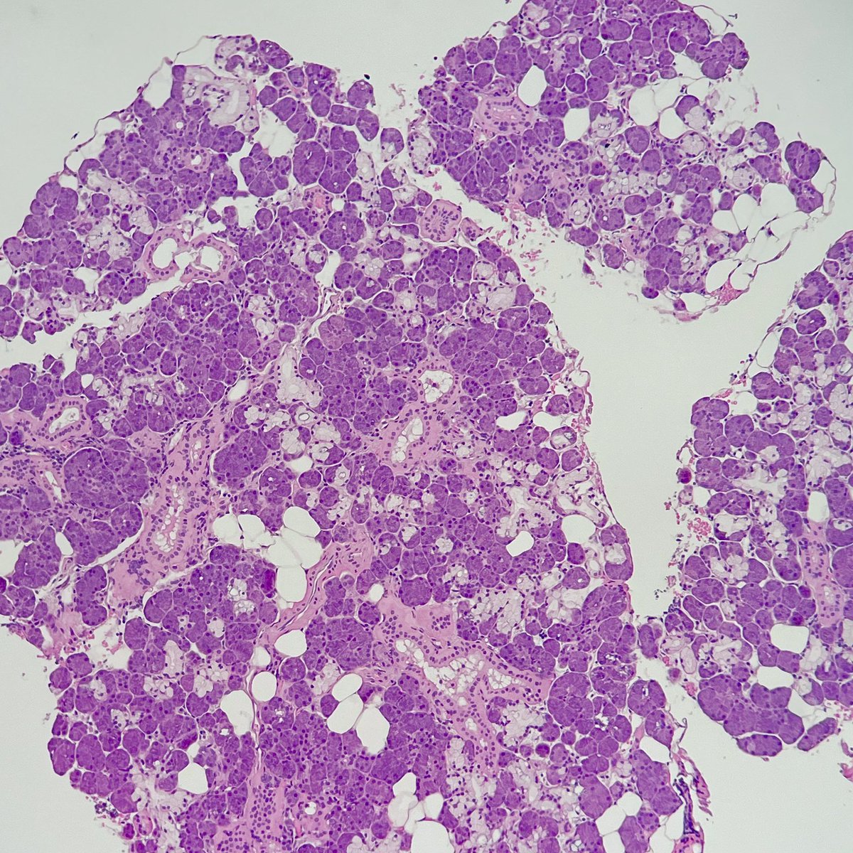 Biopsy from posterior mandible The clinician is worried about metastatic malignancy This is what you under the microscope, what is your diagnosis?