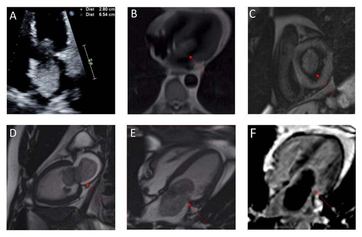 New #DeBakeyCVJournal Case Report! All that Doesn’t Enhance Isn’t a Thrombus: Pitfalls Using Cardiac MRI TI 600 Sequence to Distinguish Between Cardiac Thrombus vs Myxoma - Aakash Rana, Srikanth Vallurupalli, Mark Mitchell, David Duncan & Jack Xu

More at doi.org/10.14797/mdcvj…