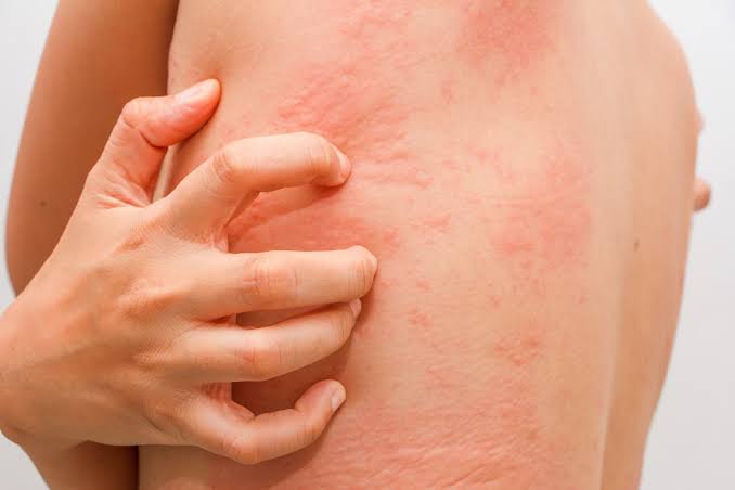 Do u have severe problem of recurrent urticaria ?? 😣
Here r some do's and don'ts for u 👇
🟢Do not eat spicy and junk food
🟢Do take additional salt in ur meal
🟢Avoid viruddha ahaar i.e taking salt in milk, fruit salad

See thread for the do's 👇👇