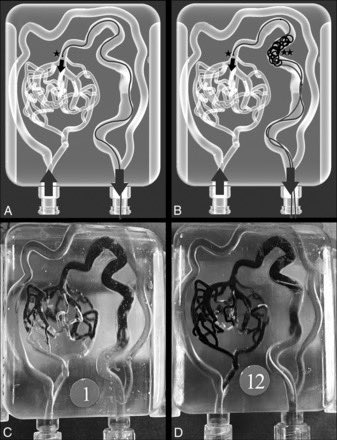 Brain Arteriovenous Malformation In Vitro Model for Transvenous Embolization Using 3D Printing and Real Patient Data ajnr.org/content/early/…