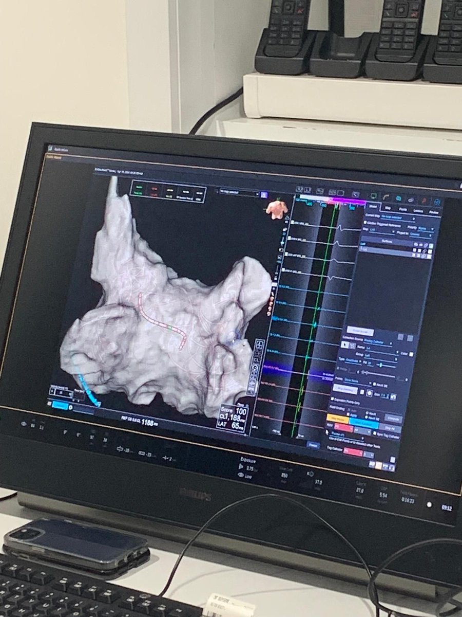 Great first case of PFA with PulseSelect at @UZBrussel congratulations to Gian Battista Chierchia, @deasnostos and all the @HRMCBrussel team @dogi84md @AndreaSarkozy @IDoundoulakis @LuigipannoneM @Edona_Ber