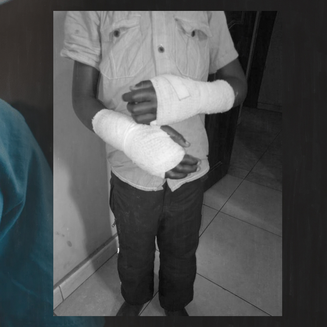 This young boy suffered severe burns to his hands and legs as a punishment by his abuser. His amazing story of recovery is testament to his strength and resilience, read more here: hopeforjustice.org/news/darkest-h…