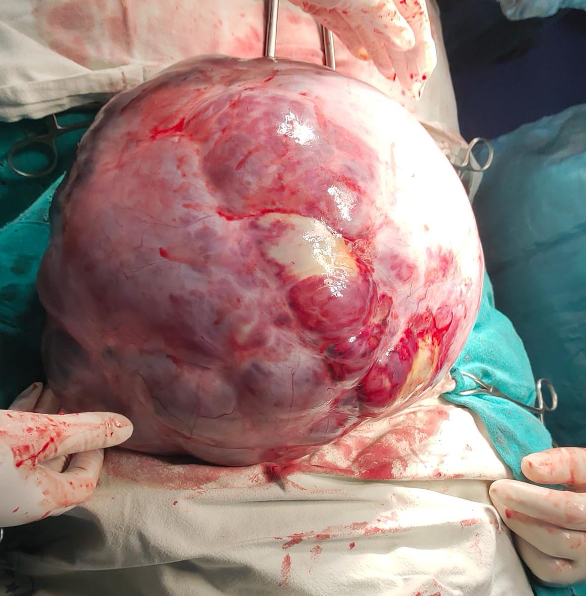Dept. of Obs. and Gynaecology operated a very rare case of a huge ovarian  tumor weighing 10 kg in a 52 year old diabetic women with previous 2 surgeries. Tumor was suspicious of malignancy intra-operatively and was removed intact . (1/2)
@MoHFW_INDIA #AIIMSBathinda