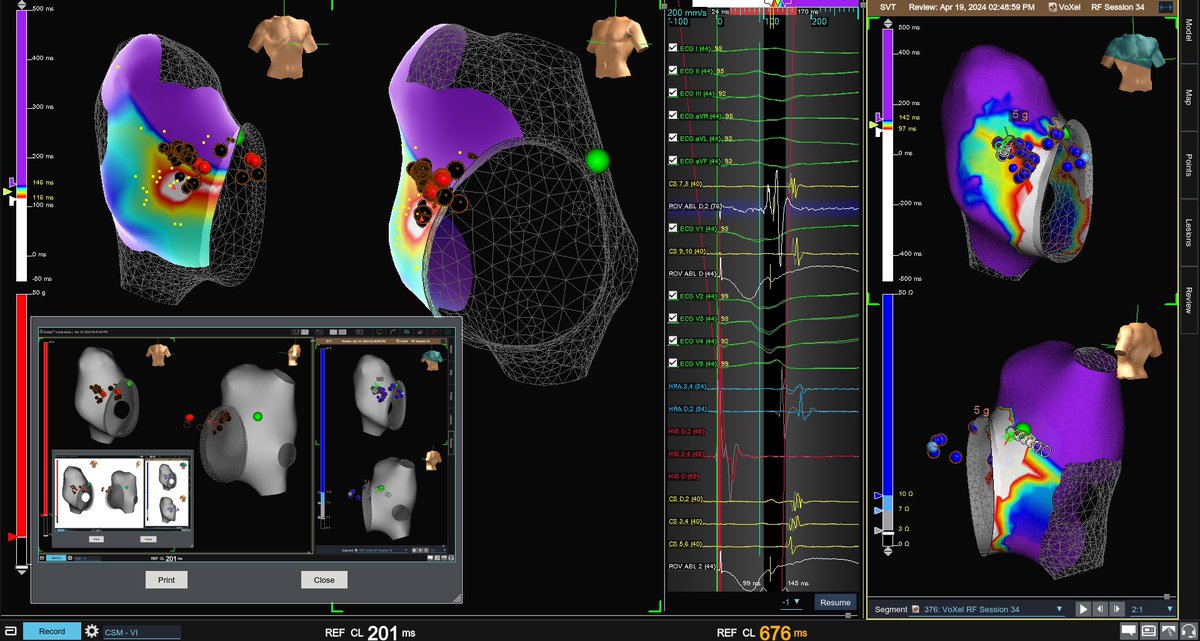 Branched and multiple AP have been described across the tricuspid. #OWM in ORT diffuse atrial activation. Ablation shifted retrograde atrial activation. Successful burns had transient AP potentials higher up. @forkknifecab_EP and I need to stare more at this. #EPeeps #WPW