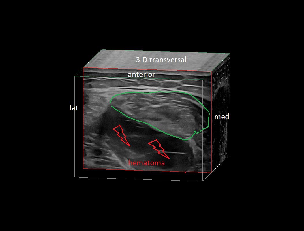 SportklinikBern's tweet photo. #muscleinjury of the #rectusfemoris myofascial with large hematoma. The player was playing with pain resulting in this large injury ##mskus #pocus #pocushub #GElogiqE10r3 https://t.co/D286emSVpj