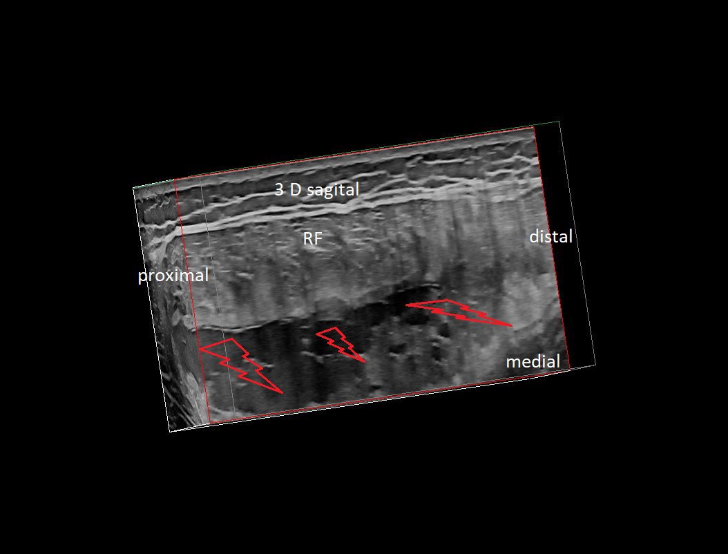 SportklinikBern's tweet photo. #muscleinjury of the #rectusfemoris myofascial with large hematoma. The player was playing with pain resulting in this large injury ##mskus #pocus #pocushub #GElogiqE10r3 https://t.co/D286emSVpj