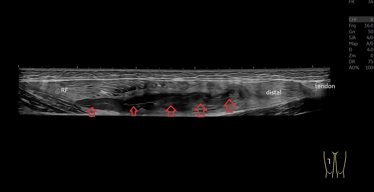 SportklinikBern's tweet photo. #muscleinjury of the #rectusfemoris myofascial with large hematoma. The player was playing with pain resulting in this large injury ##mskus #pocus #pocushub #GElogiqE10r3 https://t.co/D286emSVpj