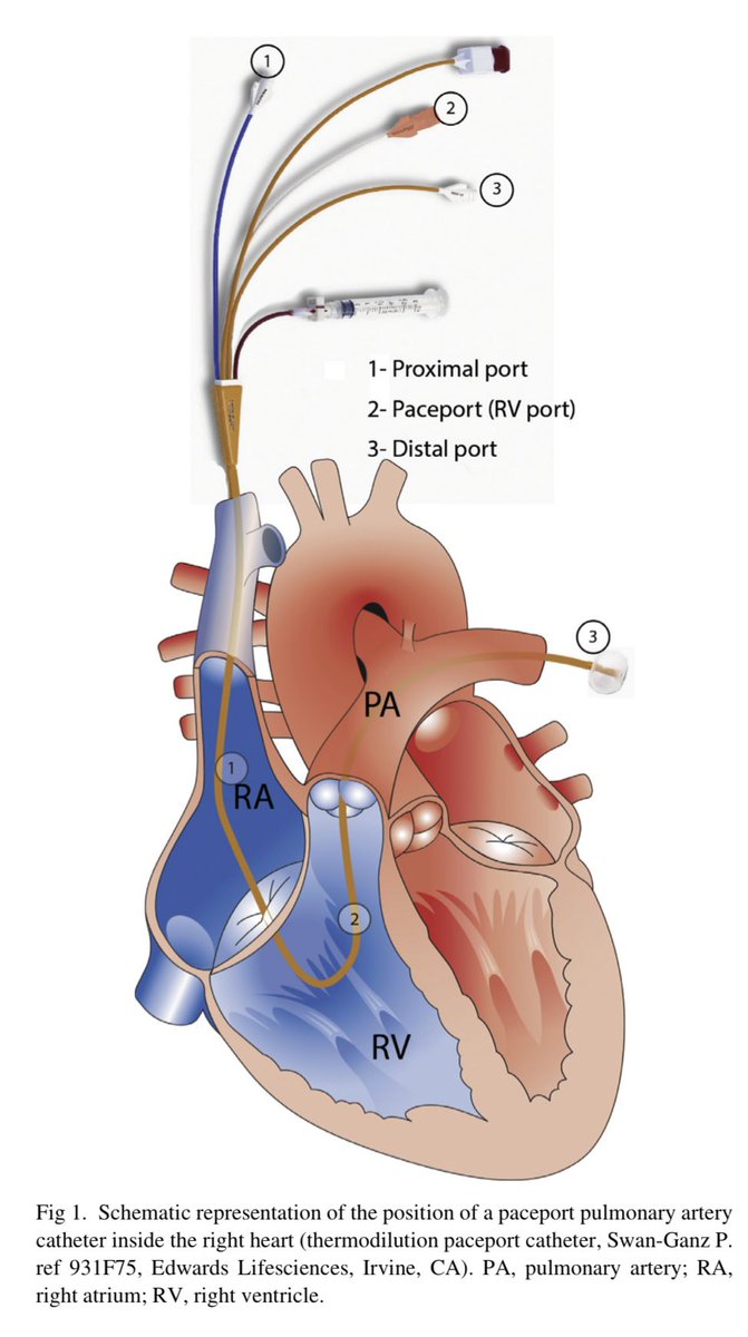 Perioperative Right Ventricular Pressure Monitoring in Cardiac Surgery. 🔗 jcvaonline.com/article/S1053-… #MedEd #FOAMcc #hemodynamics #ICU