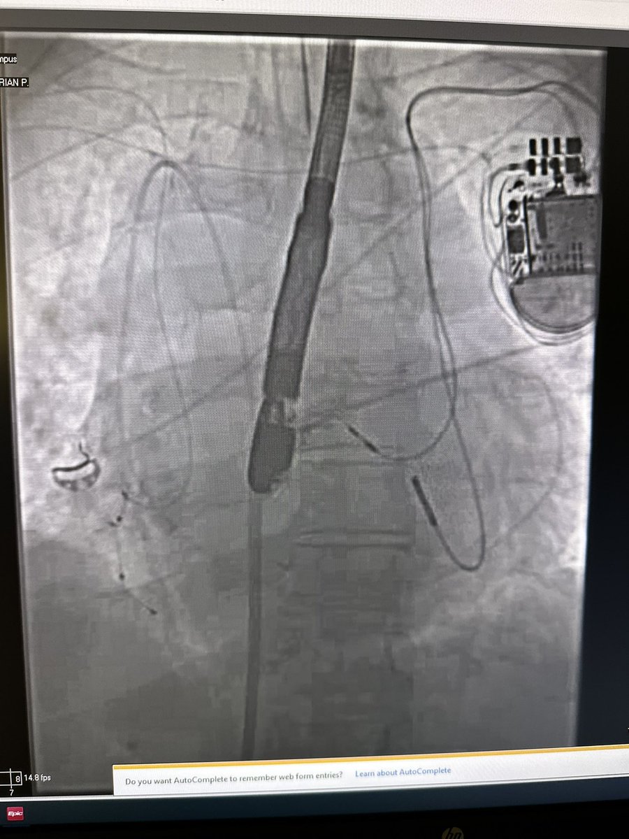 OsamaHallak5's tweet photo. Interesting anatomy of a patient with Situs Inversus undergoing #LAAO with persistent right sided IVC which prevented the implant from being completed (look at how the pigtail loops around the heart) https://t.co/weSDqPZf8W