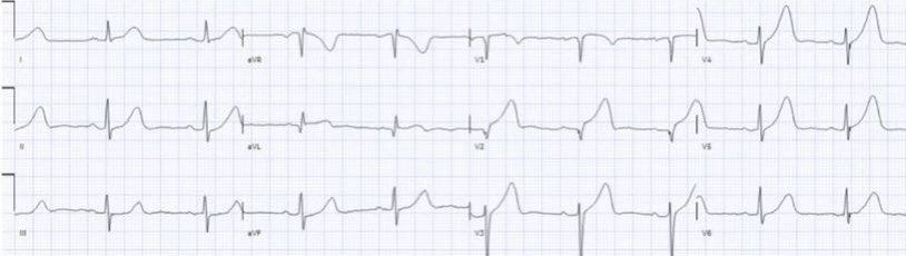 60 year old with acute chest pain and first troponin normal. What do you think? @ECGcases @EMCases #FOAMed #MedEd #Medstudent #resident #nurse #paramedic #CardioTwitter #EmergencyMedicine