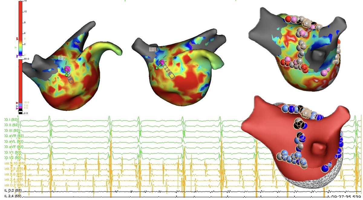 #AFib termination to #AFL at, 𝑙𝑒𝑎𝑠𝑡 fractionated location. 

With prior Cryo PVI & CTI, veins proper, remain isolated. RPV carina with residual voltage. 

Extension of RPV antrum + PW encapsulating fractionation performed. 

Atrial Flutter mapped to mid-CTI reconnection.…