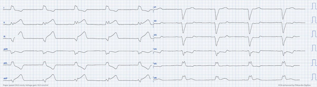 @andreaskardio @MergencyFe @ecgandrhythmRoe @kardiolancerin @RobertHermanMD QoH knows the answer: OMI ⚠️ with high Level of confidence Inferoposterior OMI @smithECGBlog @PendellM @RobertHermanMD @PMcardioApp @The_Nanashi_O @willyhfrick @BrooksWalsh @EcgOxford