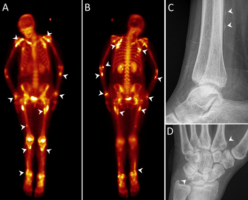 A patient with prior liver transplant presented with diffuse body pain. A bone scan and radiographs were performed. What is the diagnosis? See the answer in Images in @Radiology_RSNA: doi.org/10.1148/radiol… by @PokhrajSutharMD