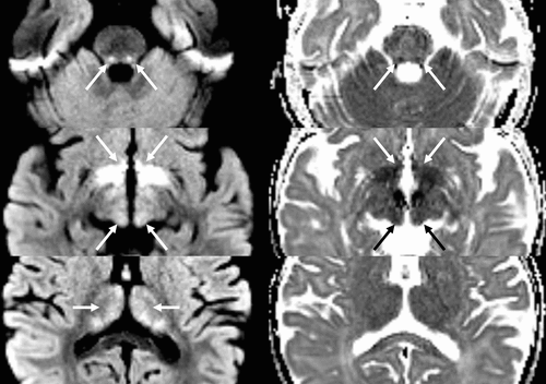 An infant with history of infantile spasms and seizures is referred for brain MRI due to ongoing seizures. What medication is the patient taking? See the answer at Images in @Radiology_RSNA: doi.org/10.1148/radiol… by @CerenDincerMD and @CanOzutemiz #neurorad