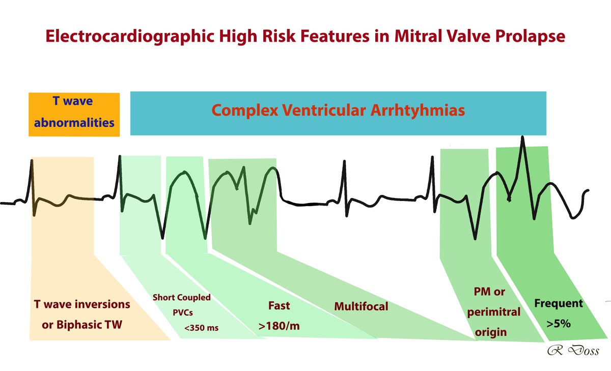 7/19 What are the high-risk ECG features? 🔶 Inferior T wave inversions/ biphasic: in 65% of patients with malignant ventricular arrhythmias(VA), but present in 40% of all patients with MVP! 🔶Complex VA: short coupled PVC, fast, frequent, multiform, PM/peri-mitral origin