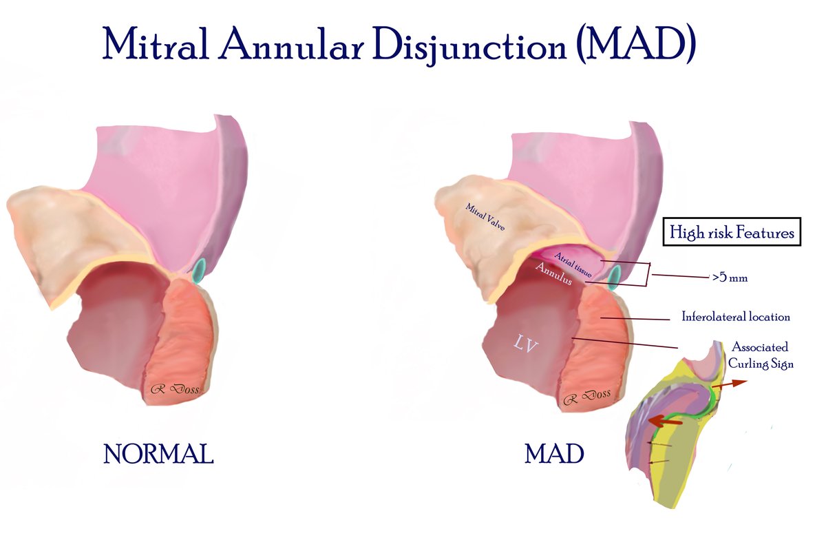 9/19 What is mitral annular disjunction (MAD)? 🔶 Abnormal atrial displacement of the hinge point of the mitral valve 🔶Associated with MVP (78%) or isolated finding (22%) 🔶 Features associated with arrhythmogenesis: depth > 5mm, inferolateral location, systolic curling!