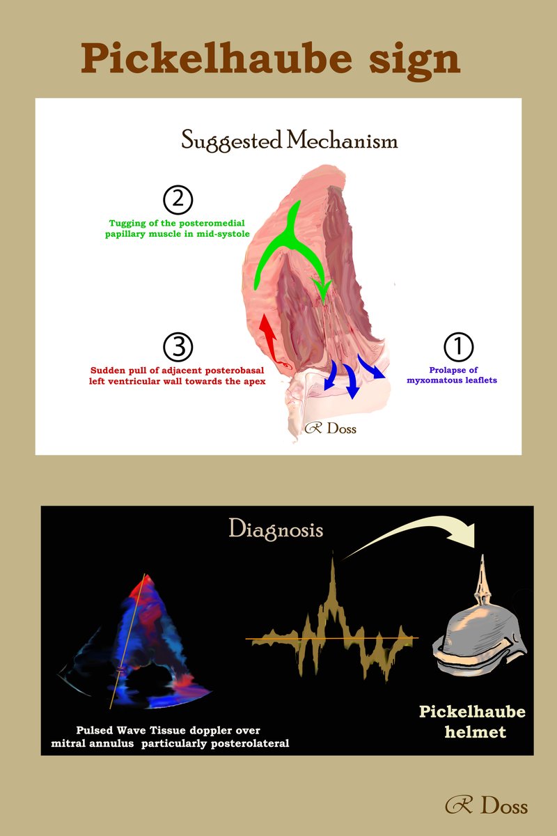 10/19 What is Pickelhaube sign? 🔶high-velocity systolic signal in the tissue doppler of MV annulus resembling the 'Pickelhaube helmet' spike 🔶> 16 cm/s = higher risk 🔶Best assessed in posterolateral annulus 🔶Mechanism: Sharp pull of the postero-basal LV wall
