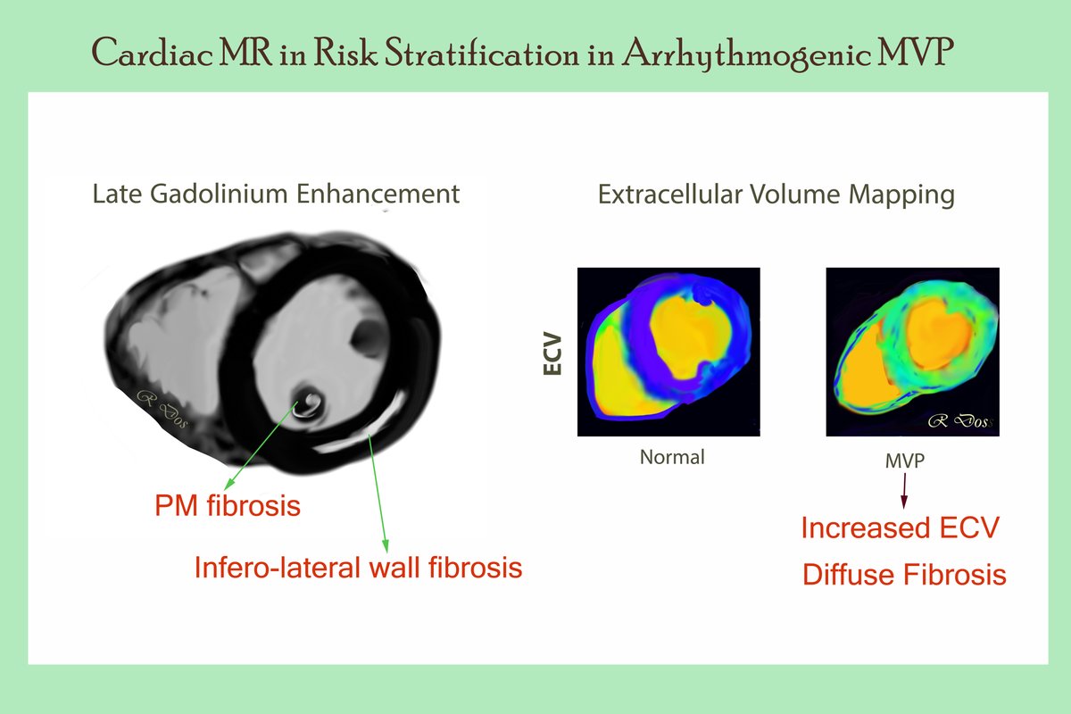 11/19 What is the role of CMR in risk stratification? In addition to similar findings to those seen on TTE , additional risk markers include: 🔶LGE: Focal fibrosis within papillary muscles and inferior/inferolateral wall 🔶T1 mapping: Diffuse myocardial fibrosis