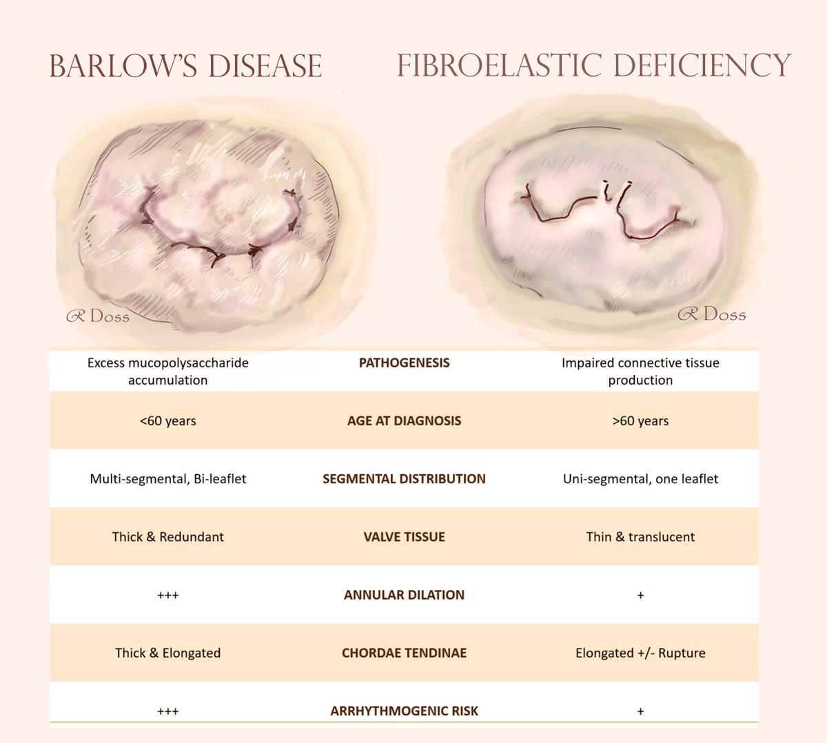4/19 There are predominantly 2 pathological forms of MVP: 🔶 Barlow’s disease: develops in younger age, diffuse bi-leaflet disease with elongated chordae 🔶Fibroelastic deficiency: develops in older age, usually affecting a single cusp with chordal rupture