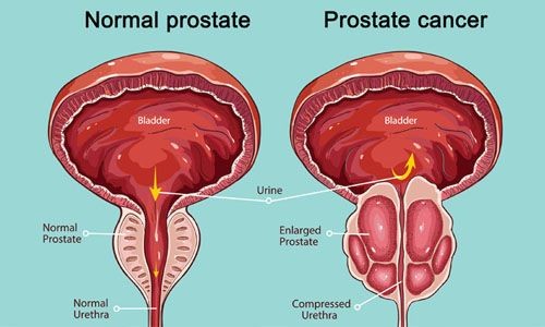 It is famously said "Men don't die of prostate cancer..they die with it." Here's what you need to know about this 'peculiar' cancer which has almost 99% survival rate.

RT to create awareness ✅