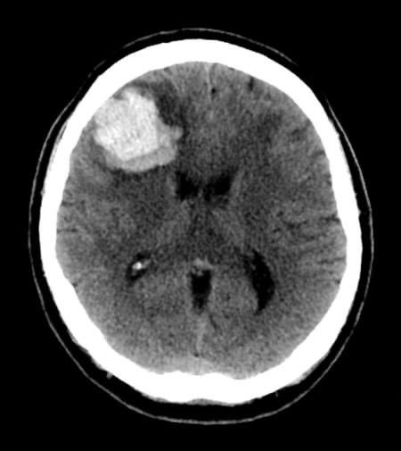 hemo_shk's tweet photo. #CTBRAIN:
Non-contrast CT brain: History of hypertension and sudden onset of left facial droop.
What does the image show?
A:Subarachnoid haemorrhage
B:Subdural haemorrhage
C:Intraventricular haemorrhage
D:Intracerebral haemorrhage
E: Enhancing mass
#MEDHM 
#MedX 
@IhabFathiSulima https://t.co/wVtiWwUWXX