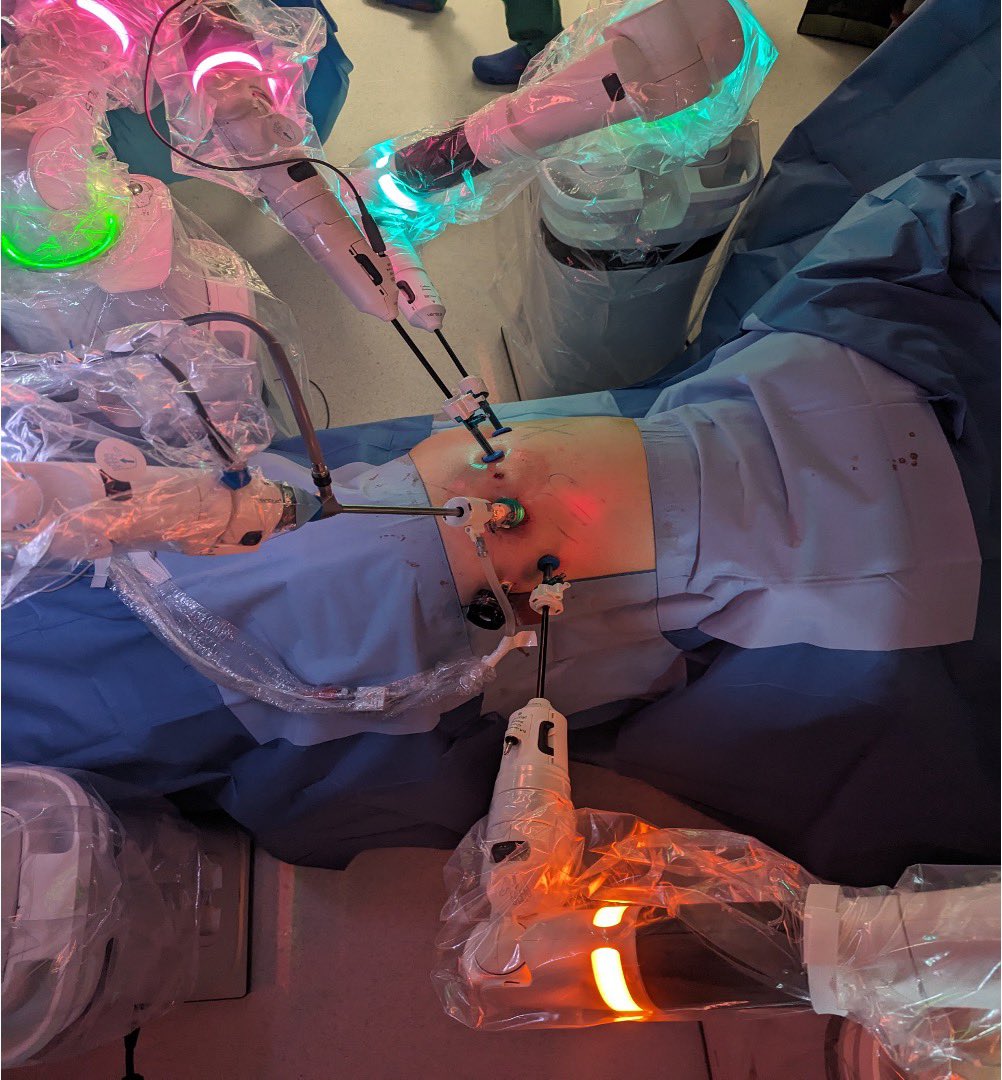 fabriziodalmoro's tweet photo. 🥇🌍FIRST CASE:
A few days ago, we performed the first retroperitoneoscopic nephrectomy at the Urology Department in Padua using the VERSIUS robotic system. The postoperative course was excellent, and the patient had already been discharged 👍. 
📖To our knowledge, no reported cases in the literature of retroperitoneal approaches for renal surgery using this robotic system exist. 
Special thanks to all the members of my fantastic team!!!
♥️The value of teamwork!