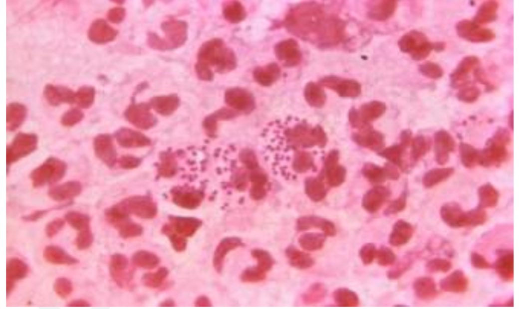 A man presents with a history of dysuria and urethral discharge after having unprotected sexual intercourse. Gram-staining of the purulent discharge is seen in the following image.
What is the treatment of choice for this infection?

1:Erythromycin
2:Azithromycin
3:Ceftriaxone