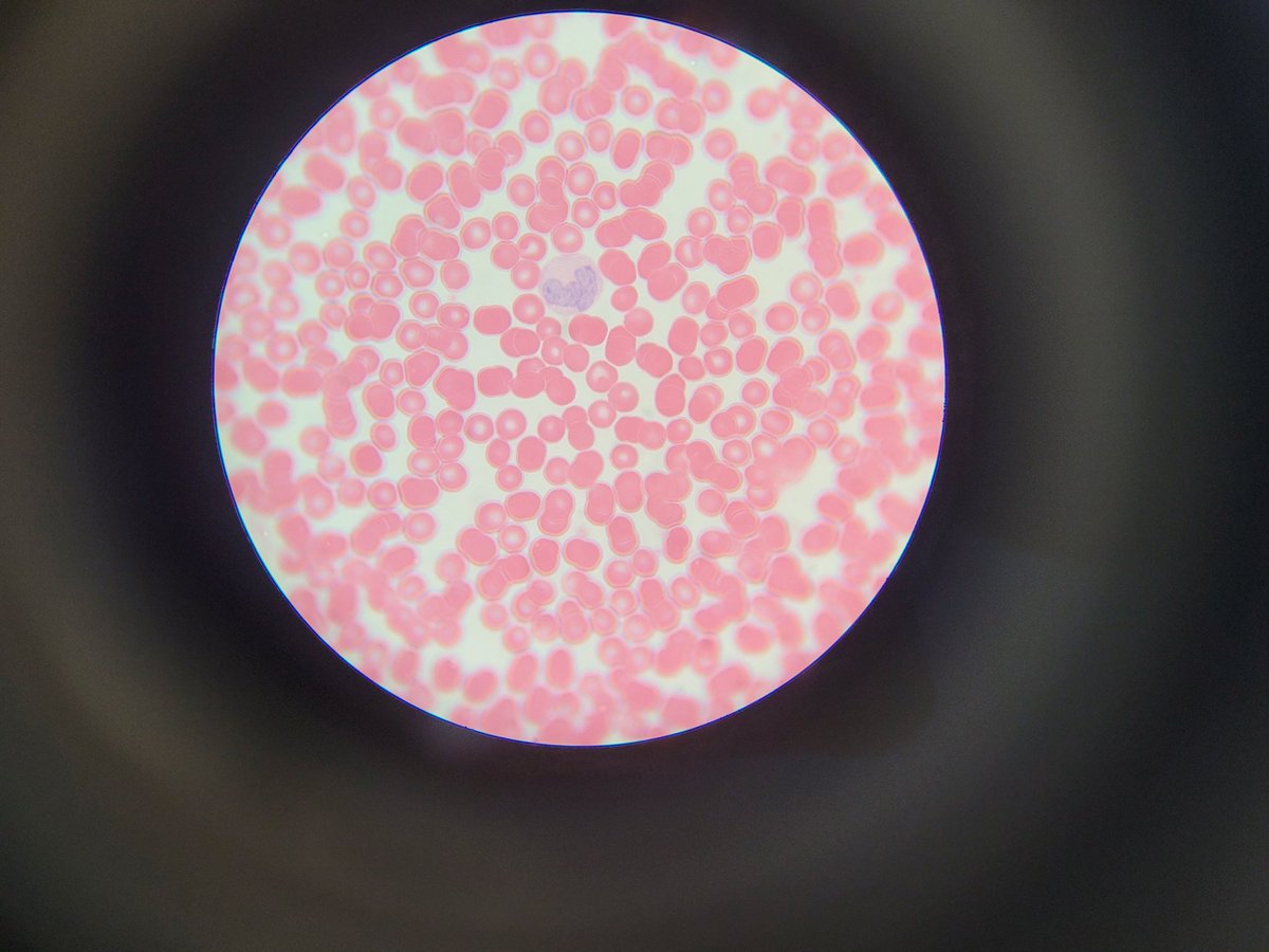 Another successful Open Day @AberDLSAGB treated the Micro/Biochem/Genetics/Biology crew to a #monocyte hunt, a #catalase test & a #resazurin viability assay! Nothing quite like the excitement of finding your 1st #monocyte or #neutrophil on a blood smear! #Immunology #microbiology