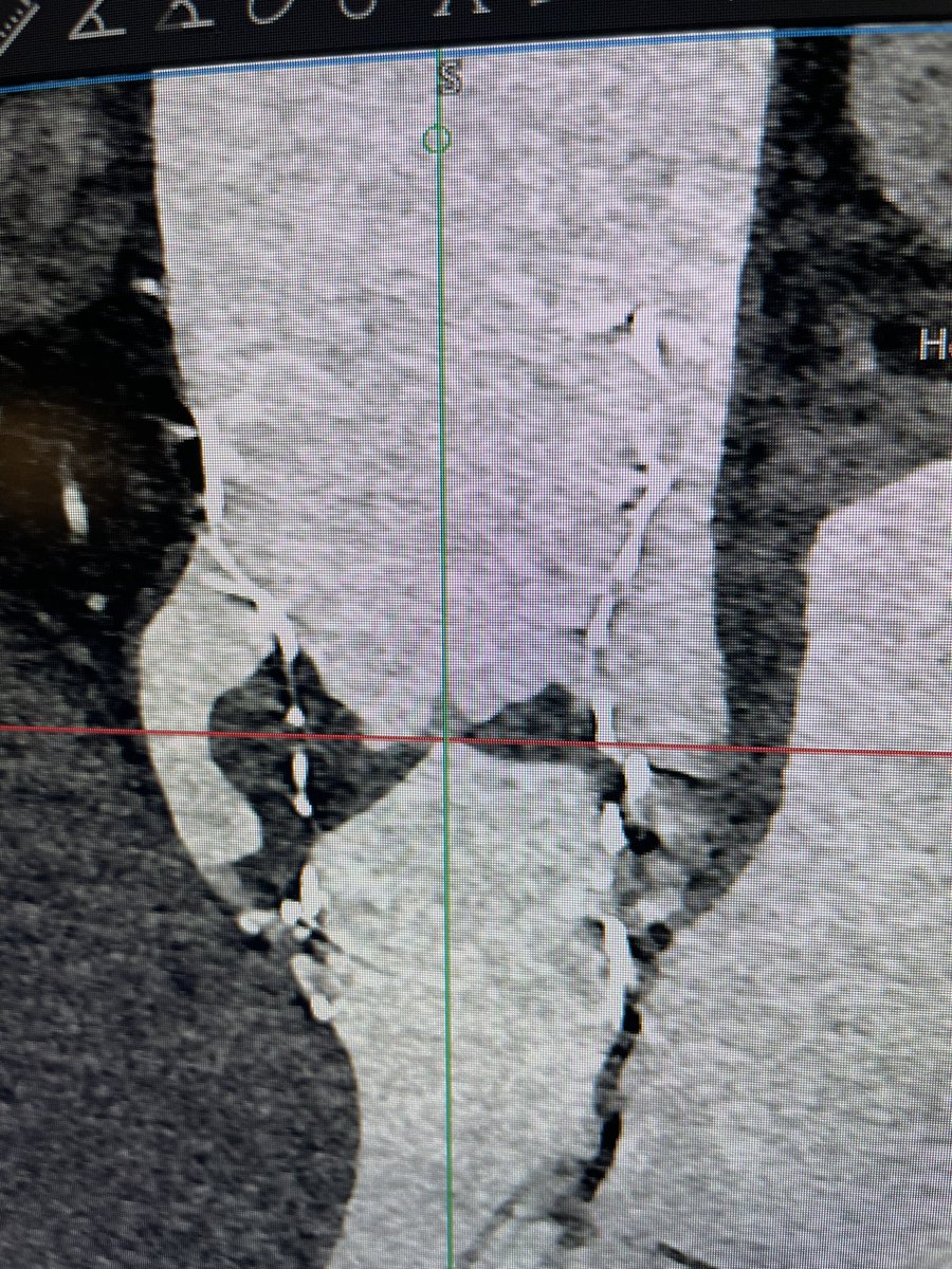 2 yrs s/p ViV TAVR with 26 E Pro+ in a 25 CE with MI presentation- MG 9 in June 23, now 35. Huge sinuses, circular deployment.