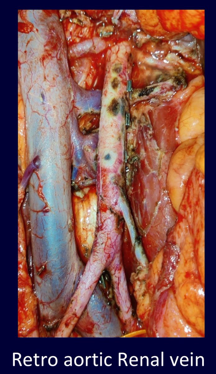 TCa D20 :

Be wary of the retro aortic renal veins .. during interaortocaval and para aortic dissection .. esp when they are the only ones .. seen in 0.5-3%