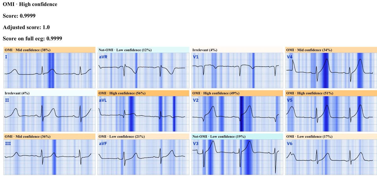 @heartsECGcourse @ECGcases @EMCases Rightly so, the Queen cannot be more confident - as this ECG nicely demonstrates many important concepts of the OMI paradigm: 1) hyper-acute T waves, 2) proportionality, 3) poor-R wave progression and S-persistence, 4) STE that does not meet criteria, 5) subtle mirror STD.
