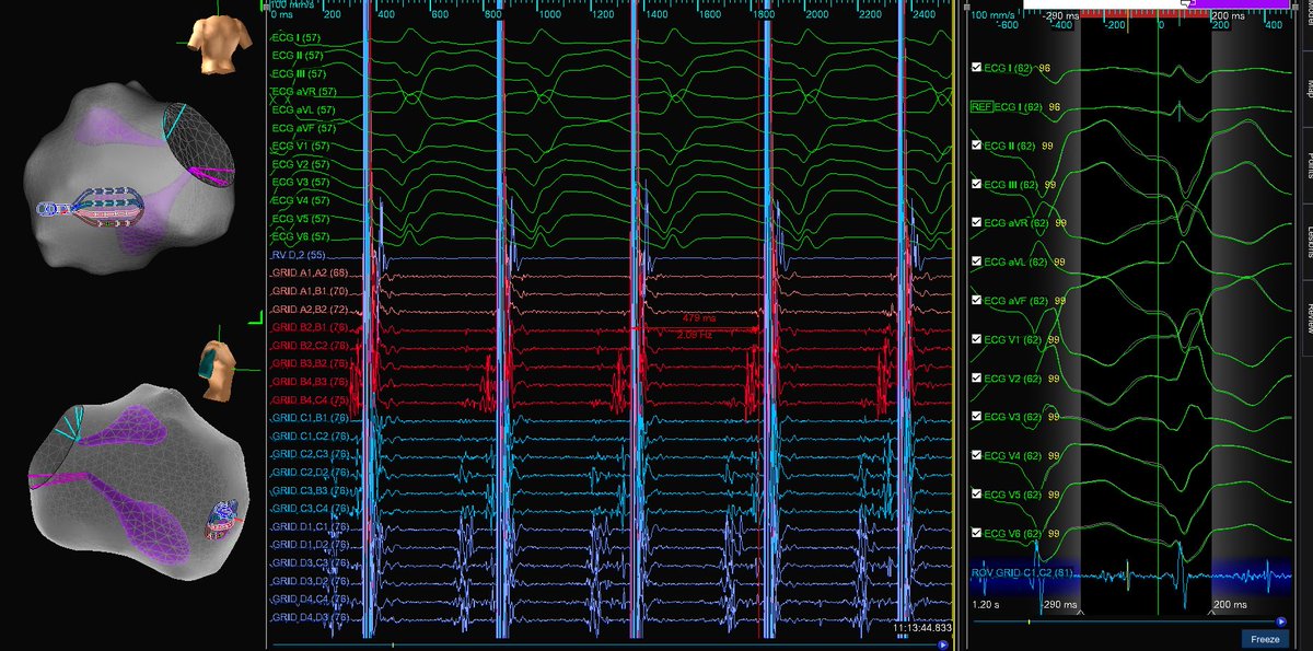 Favorite part of this previously shared Ischemic VT, #Entrainment of course. Though manifest, still a beautiful example of Downstream Pacing with long stimulus to Upstream Capture, 'StaMP'd' with #HDGrid at LV apex. @CRB_EP @DrGregMichaud @JeffHsingMD #EPeeps #PMA