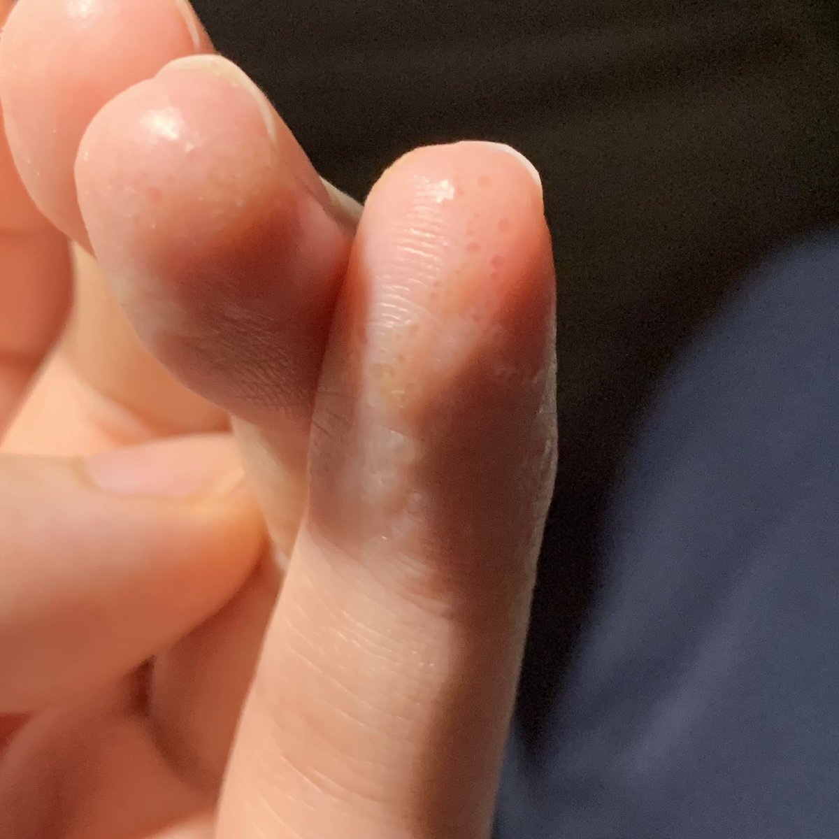R__716__'s tweet photo. 去年の夏になった指先だけに集中した汗疱と
6年前くらいから出始めて徐々に酷くなっていった蕁麻疹(全身ランダム)
これだけで睡眠妨害だし
この針で刺したような無数のプツプツ汗疱がずっと繰り返すせいで本当に何も触りたくない
いつまでも治らない https://t.co/KTRlGL0UOc