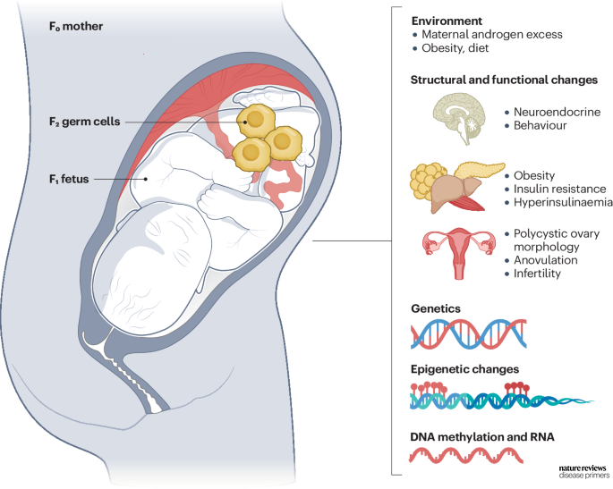 DiseasePrimers's tweet photo. The inheritance of #PCOS likely involves genetic, environmental and epigenetic factors https://t.co/wUlyWBG5Pk https://t.co/HIRVQMAfID