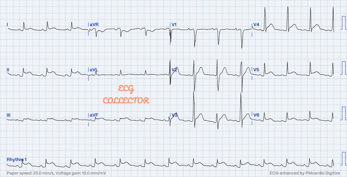 Sometimes it's hard to tell based on #ECG.