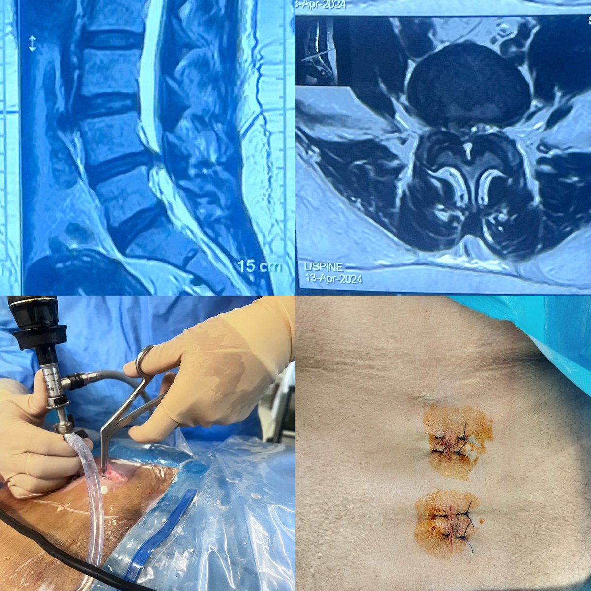 Unilateral Biportal Endoscopic (UBE) in a morbidly obese 40 years old lady having right leg pain and numbness due to right sided L4-5 sequestered disc. #OrthoTwitter #MedTwitter #Spine