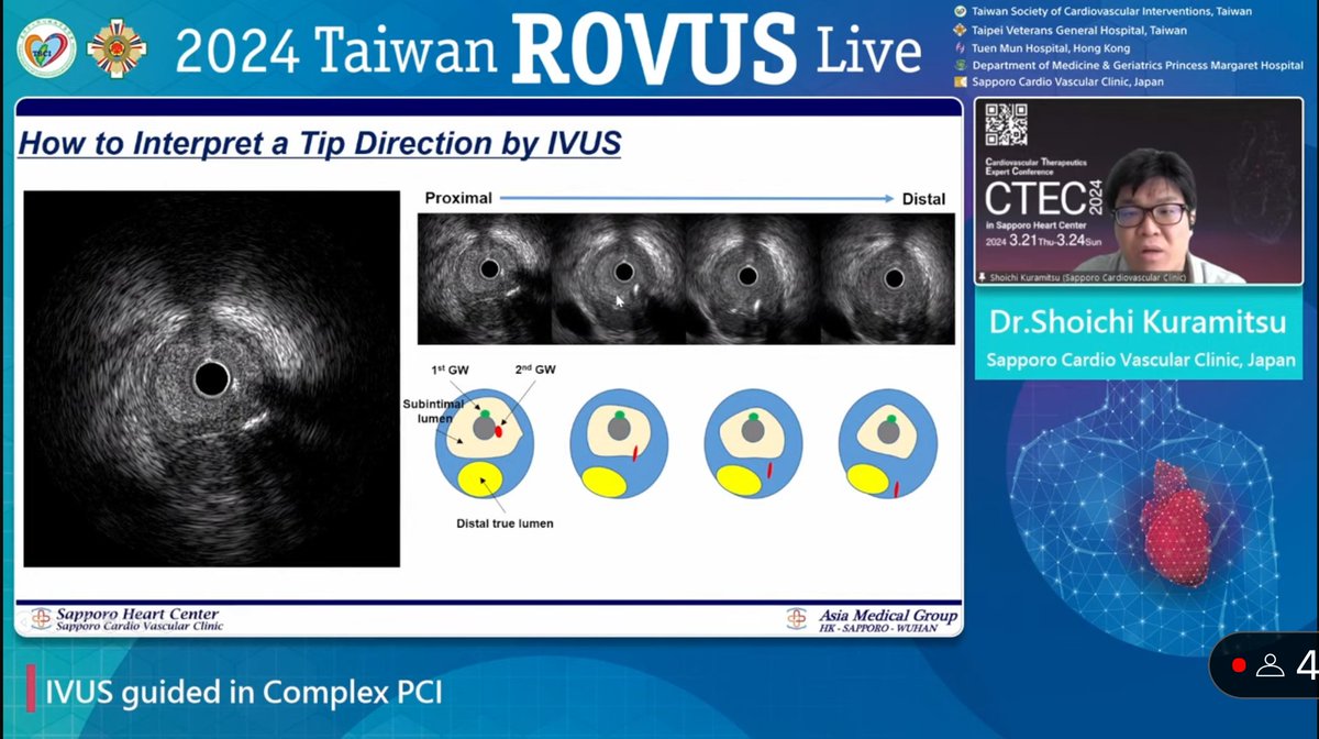 2024 Taiwan ROVUS Live was successfully concluded. SCVC's intravascular imaging experts, Dr. Umihiko KANEKO and Dr. Shoichi KURAMITSU shared their vast expertise and experience about imaging-guided PCI treatments. Kudos to Dr. KANEKO and Dr. KURAMITSU!