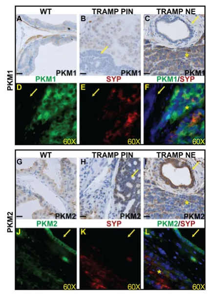 chengsiyuan1004's tweet photo. Excited to share our recent study on #NEPCa and #ProstateCancer! We explored PKM isoform expression patterns in prostatic tissues, shedding light on metabolic shifts in aggressive prostate cancer subtypes. Congrats to @malinda70646503 @Susie34311496
https://t.co/VTQpZ9AMWj https://t.co/h5UWlN36bR