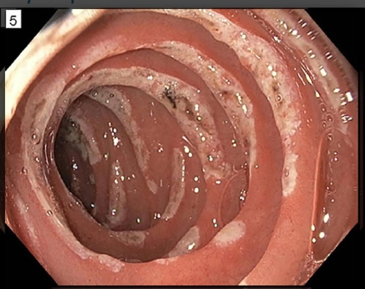 🟣𝘾𝙇𝙄𝙉𝙄𝘾𝘼𝙇 𝙎𝘾𝙀𝙉𝙀𝙍𝙄𝙊:-

📝A patient p/w abdominal pain, chronic diarrhea & weight loss.Patient gives h/o of therapy resistant Peptic #ulcers.His serum #gastrin level is >1000pg/ml

💅What is likely diagnosis?? 🤔

#medx #medEd