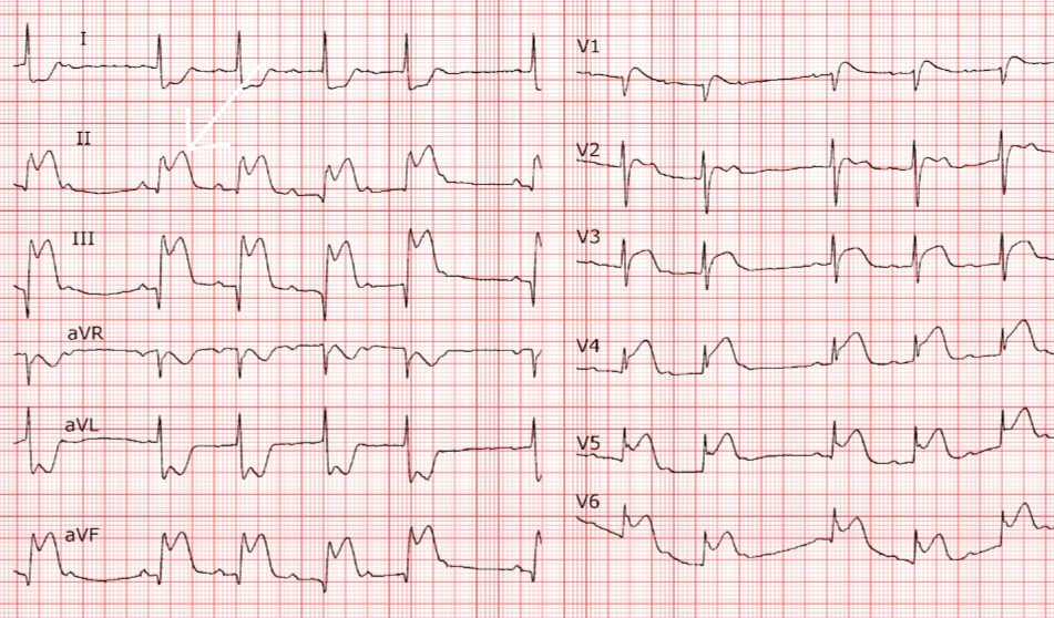 ECG spot Diagnosis 
Case 9.

71yrs M presents with excruciating chest pain that started about 2 hrs ago.

1. Diagnosis?
2. What coronary artery territory is implicated?
3. Treatment?