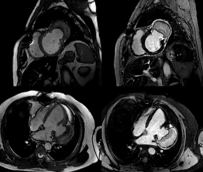 A 48-y-o male with #NSTEMI was found to have 3 vessel diseases and underwent triple coronary artery bypass. One year later, he presented with worsening exertional dyspnoea. View this image submitted by a team from 🇵🇹 and selected for #EuroPCR and participate in the quiz